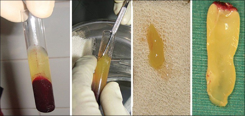 Platelet Rich Fibrin What is PRF PRF for dental