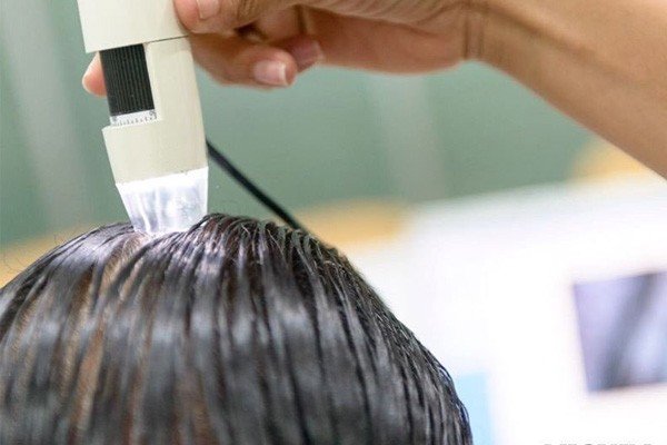 PRP Hair Loss Treatment Before and After Precautions Image - PRP