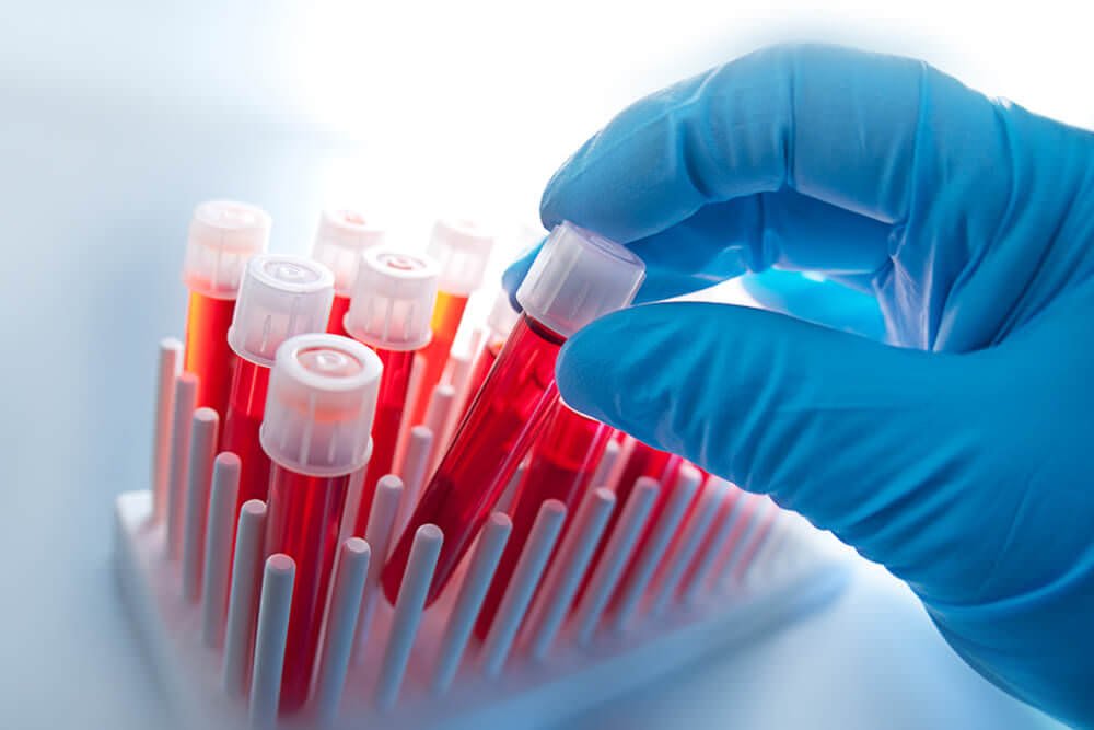 PRP Hair Loss Treatment