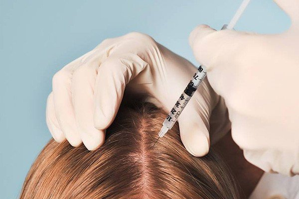 How Many PRP Treatments are Needed for Hair Loss Image - PRP