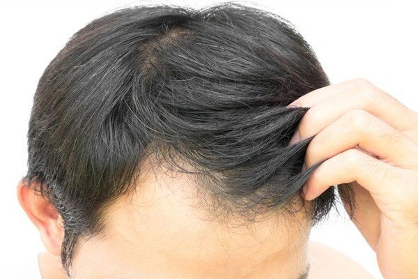 Is PRP Hair Treatment Permanent Solution Image - PRP