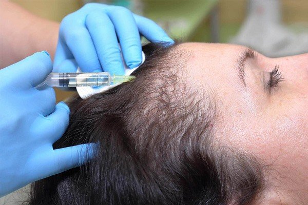 Image result for Undergoing a Hair Transplant in the United Kingdom can Cost Higher