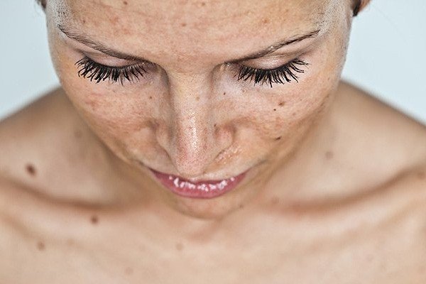 Sun Damaged Skin and Discoloration Image - PRP