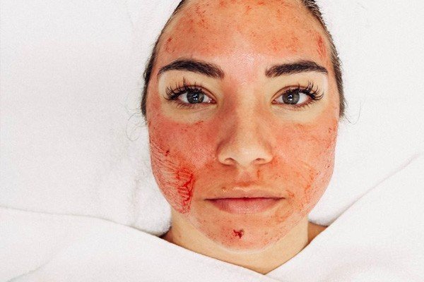 Vampire Facial Recovery Time Image - PRP